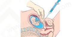 آمنتیوسنتز در بارداری