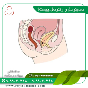 سیستوسل و رکتوسل چیست؟